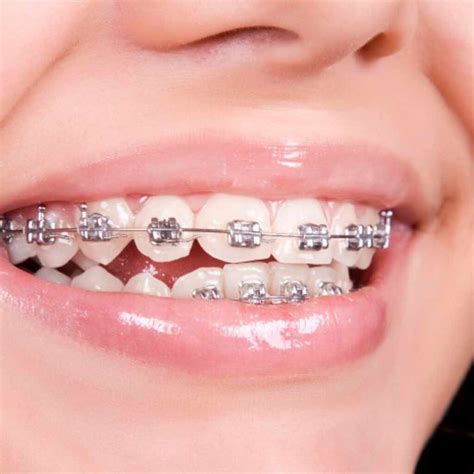 Ortodoncia fija con brackets metálicos 